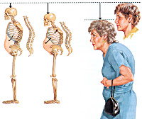 Постменопаузальный остеопороз: Постменопаузальный остеопороз