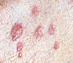 Псевдолимфомы кожи: Псевдолимфомы кожи