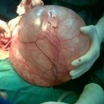 Псевдомуцинозная кистома яичника: Псевдомуцинозная кистома яичника