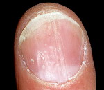 Псориаз ногтей: Псориаз ногтей