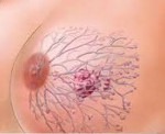 Рак молочной железы у беременных: Рак молочной железы у беременных