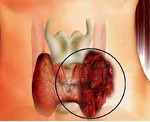 Рак щитовидной железы у беременных: Рак щитовидной железы у беременных