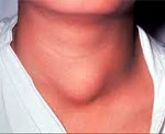 Рак щитовидной железы: Рак щитовидной железы