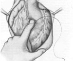 Ранения сердца: Ранения сердца