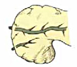 Расщепленная поджелудочная железа: Расщепленная поджелудочная железа