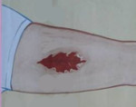 Рваная рана: Рваная рана