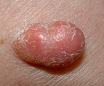 Ретикулогистиоцитома кожи: Ретикулогистиоцитома кожи