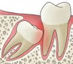 Ретинированный зуб: 