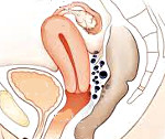 Ретроцервикальный эндометриоз: Ретроцервикальный эндометриоз