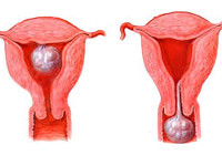 Рождающийся миоматозный узел: Рождающийся миоматозный узел (Экспульсия миоматозного узла)