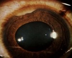 Саркоидоз глаз (Офтальмосаркоидоз)