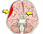 Сдавление головного мозга: Сдавление головного мозга